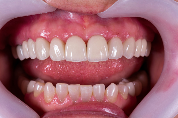 Do&# ;s And Don&# ;ts Of Dental Crown Care