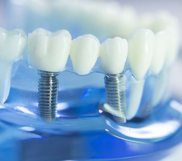 Chillicothe Dental Implants