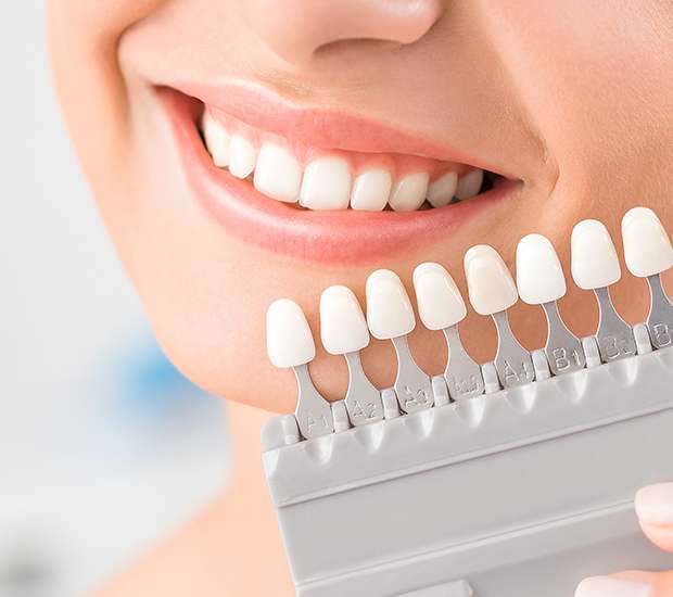 Chillicothe Dental Veneers and Dental Laminates
