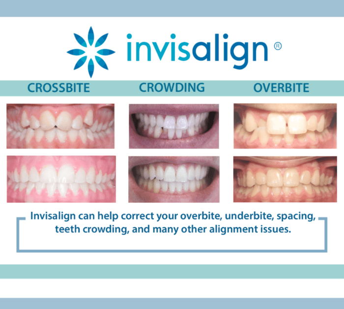 Invisalign vs Braces