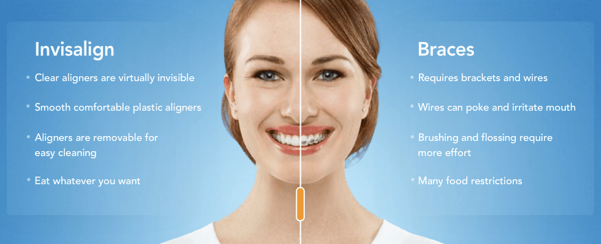 Invisalign vs Braces