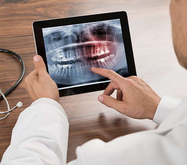 Chillicothe Types of Dental Root Fractures